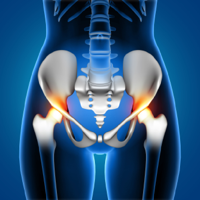 Total Hip Replacement (THR) surgery in pune